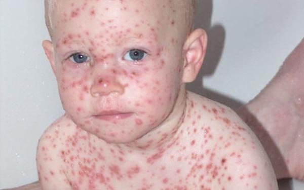 Facts about Chickenpox