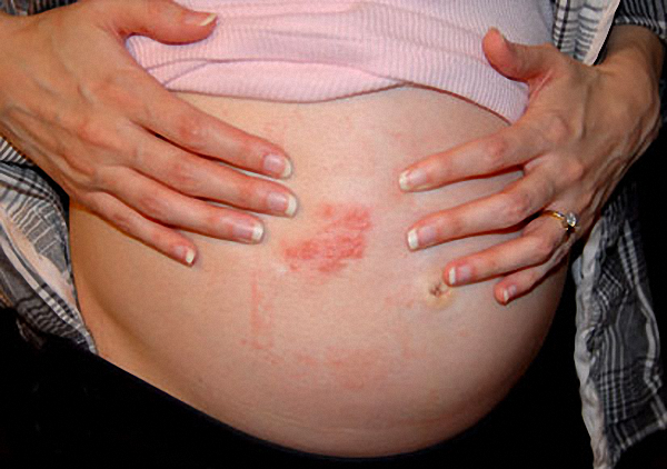 Shingles Treatment during Pregnancy