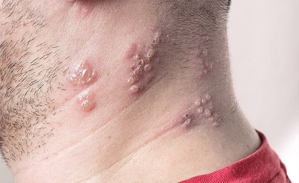 What causes shingles to reoccur