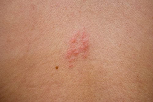 Shingles sign and symptoms