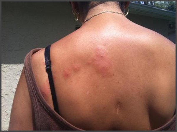 Picture of Shingles rash on back of women