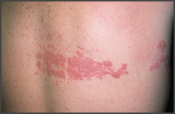 Picture of Shingles rash on body