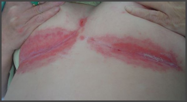 picture of shingles rash on breast