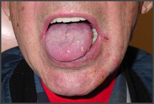 Shingles In Mouth Pictures Shingles Expert