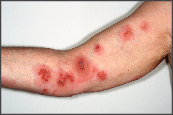 pictures of shingles on arm