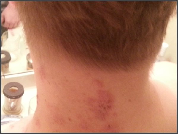 pictures of shingles on back of neck