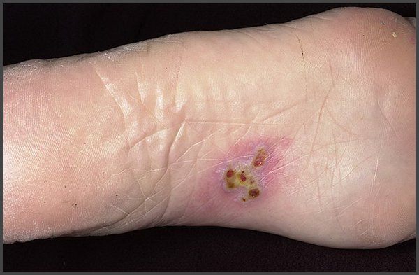 pictures of shingles on bottom of feet
