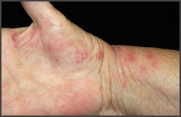 pictures of shingles on palm of hand