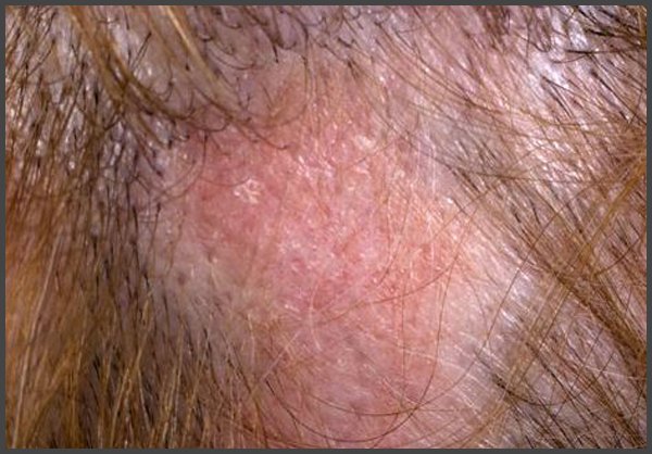 pictures of shingles on your scalp