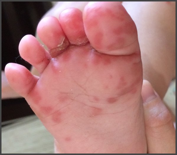 pictures of shingles rash on feet