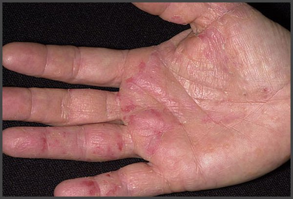 pictures of shingles rash on hands