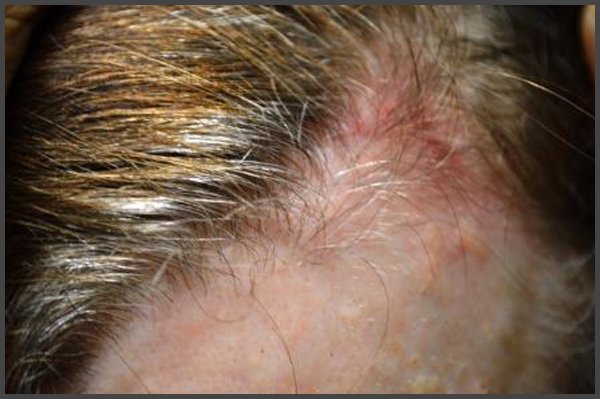 pictures of shingles rash on scalp