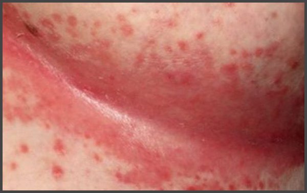 pictures of shingles rash under breast