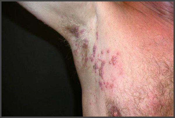 pictures of shingles under the armpit