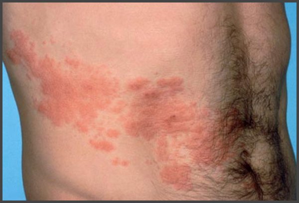 shingles groin pictures