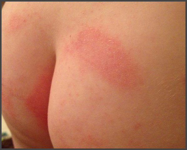 shingles in buttocks crack pictures