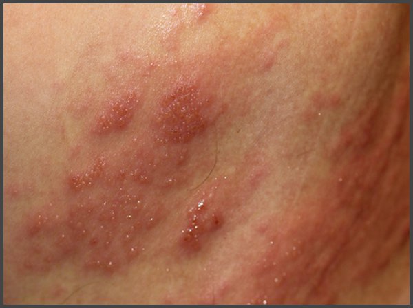 shingles in groin area pictures