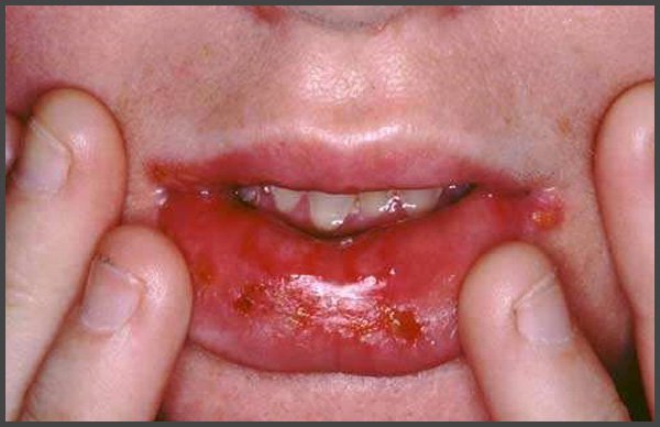 shingles in mouth and throat pictures
