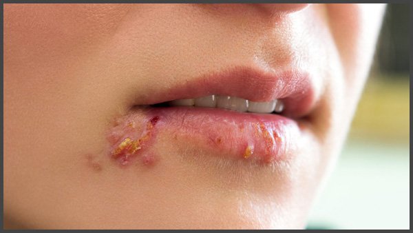 shingles in mouth pictures