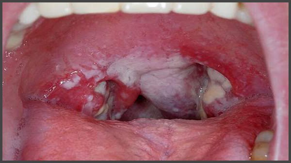 shingles in throat pictures