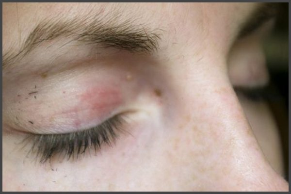shingles in your eye pictures