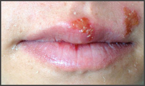shingles mouth sores pictures