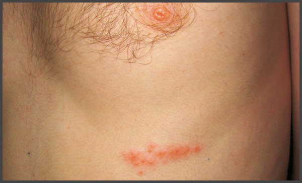 shingles on breast pictures