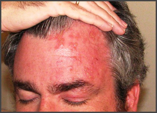 shingles on forehead pictures