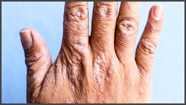 shingles on hands pictures