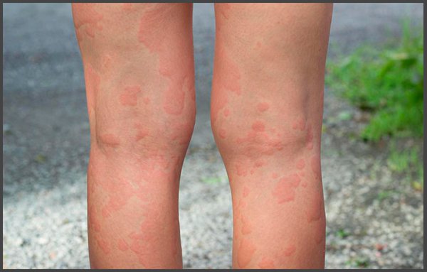 shingles on leg pictures