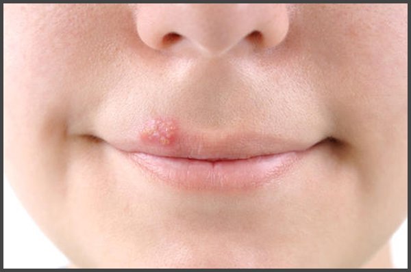 shingles on lips pictures