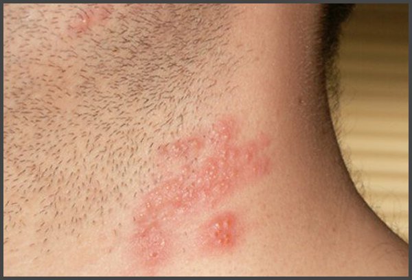 shingles on neck pictures