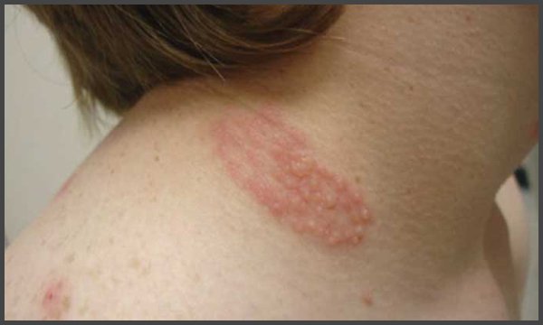 shingles rash on neck pictures