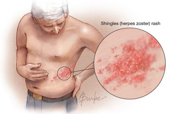 shingles rash